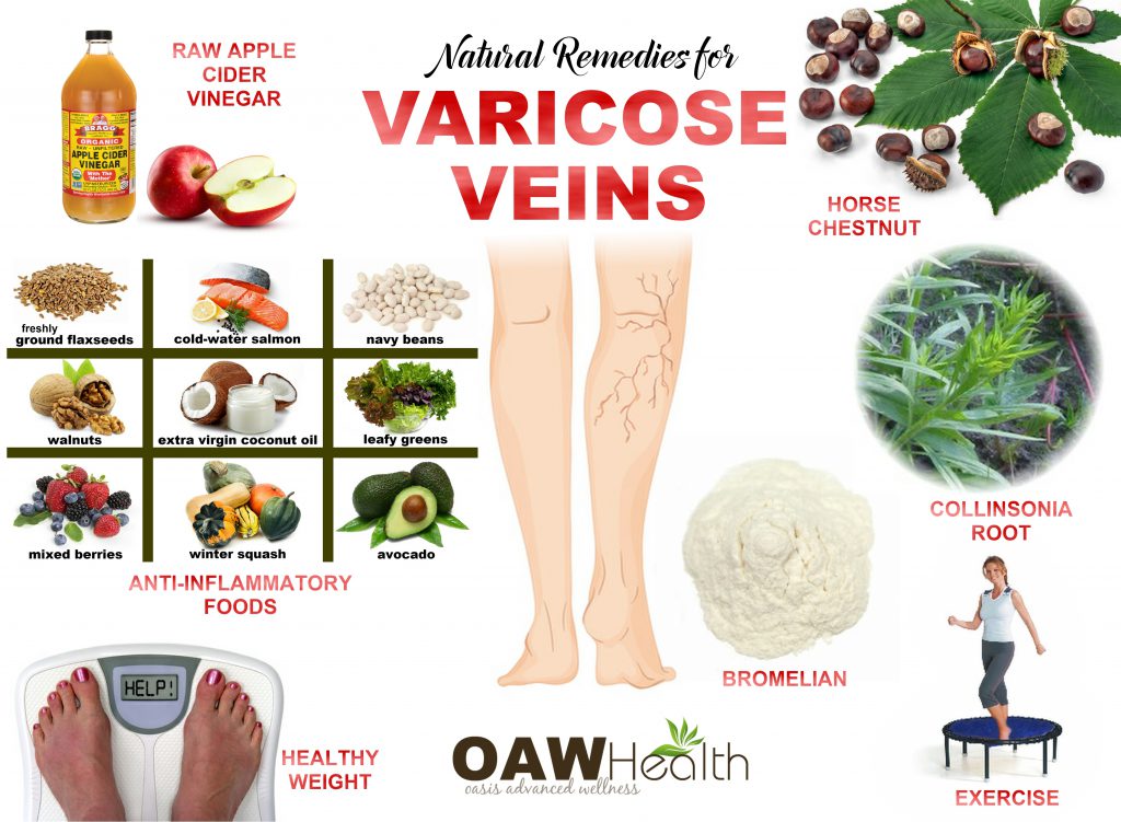 varicose veins - chart